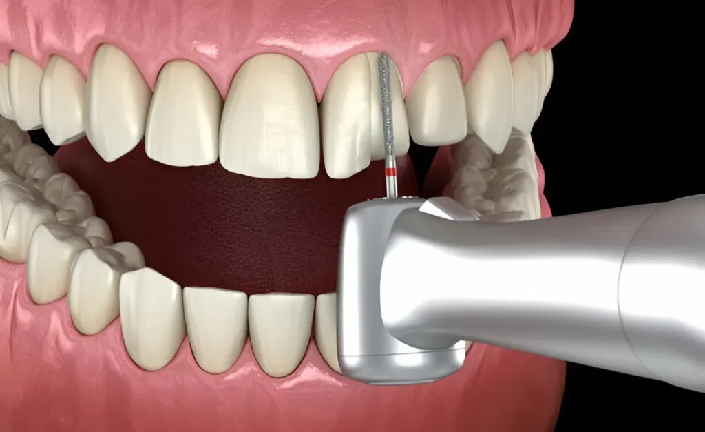 What Is Dental Bonding and When Is It the Right Choice? What Is Dental Bonding and When Is It the Right Choice