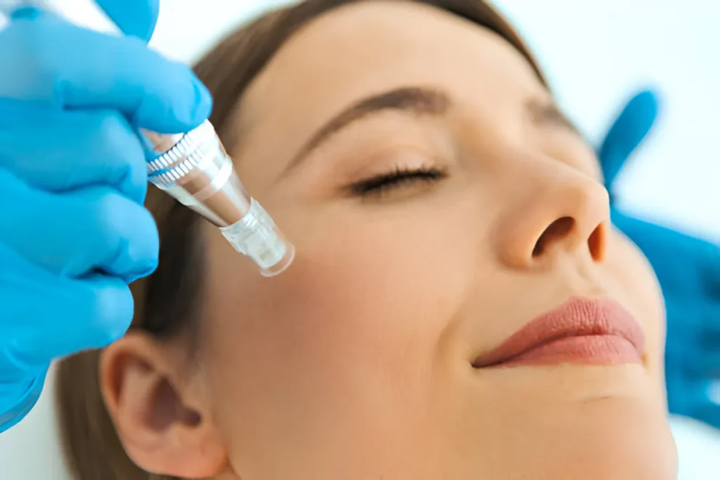 Unlocking Youthful Radiance: The Wonders of Skin Needling