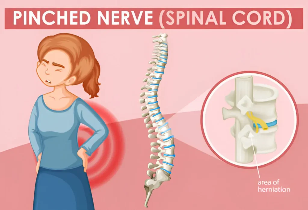 Expert Tips for Locating Quality Pinched Nerve Treatment Near You