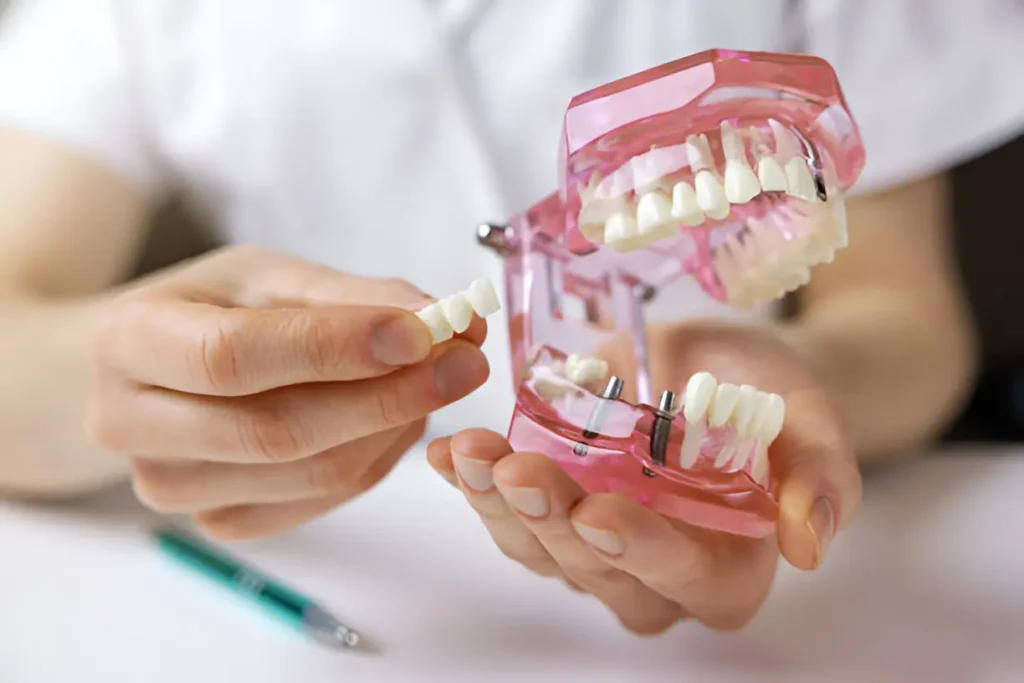 Revolutionizing Smiles The Benefits of a Dental Implant Bridge