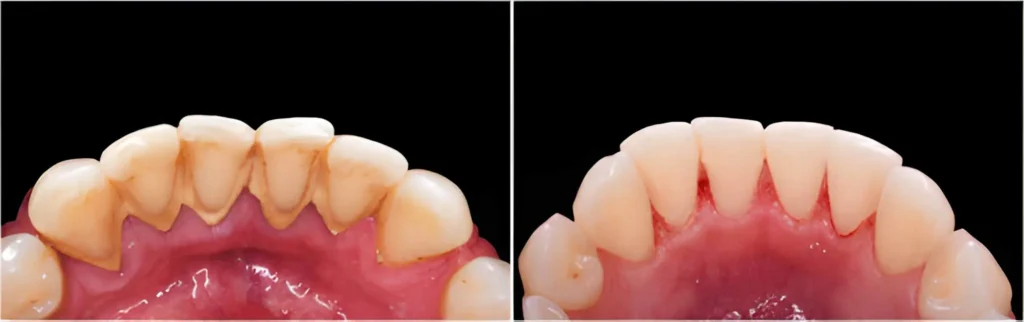 Edge Bonding For Worn Teeth: Restoring Youthful Shape And Shine Edge Bonding For Worn Teeth Restoring Youthful Shape And Shine