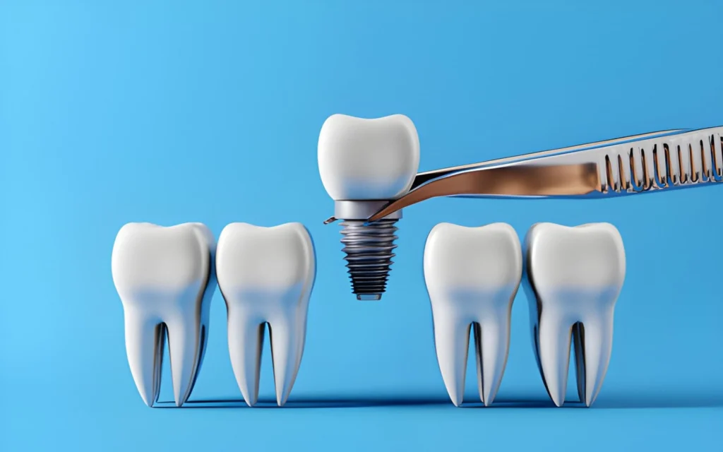 Dental Implants And Periodontists: Protecting The Foundation For Success
